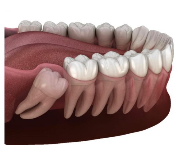 دندان عقل نهفته